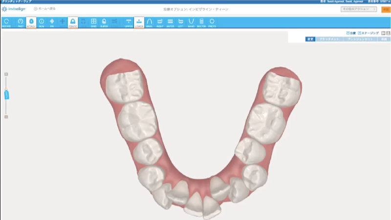 歯列矯正にもデジタル技術 3dスキャンやオンライン相談アプリを投入するインビザライン ジャパン Digital X デジタルクロス